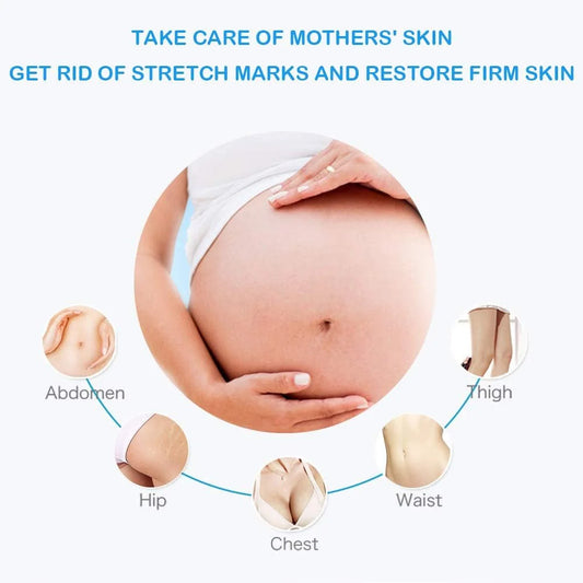 Stretch Mark Treatment Cream